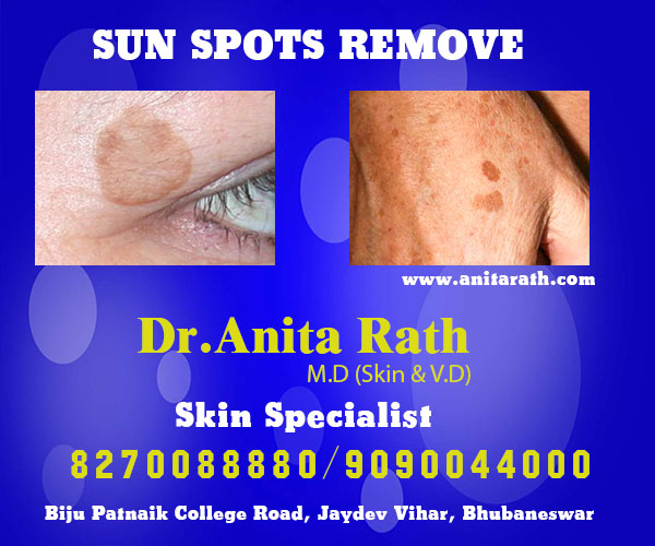 Best sun spots remove clinic in bhubaneswar near capital hospital